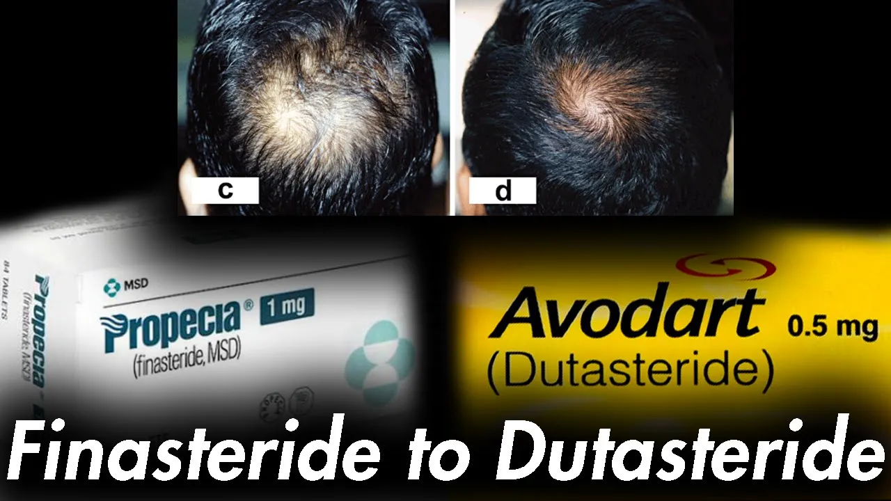 Dutasteride Loading Phase According to Literature