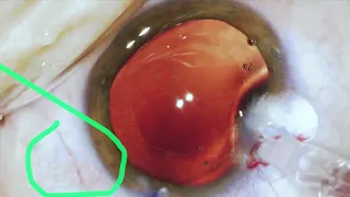 Zepto Cataract Surgery Dr Vance Thompson