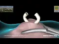 Vasectomy - CIMS Hospital