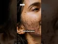 Download Lagu 2 Types of Acne | Inflammatory Acne vs Noninflammatory Acne