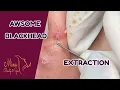 Download Lagu AWESOME BLACKHEADS EXTRACTION | Mina Spa | Suri | Nguyen |