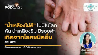 ทำไมคนที่มีผื่นภูมิแพ้จึงมักถูกเรียกว่า 'น้ำเหลืองไม่ดี'