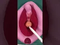 Como é feita a colocação do DIU ?