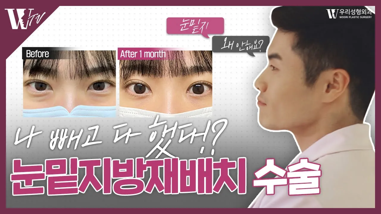 나 빼고 다했다!! 눈밑지방재배치