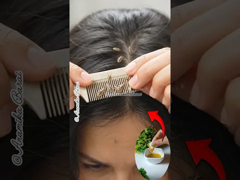 😳Lice Removal Hair Oil/Best Oil For Nits & Lice #shorts #liceremoval #nits #hairoil #youtubeshorts