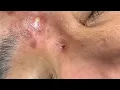 Suri Job Awesome Big Blackheads Extraction on Forehead
