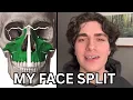 I Felt My Face Split in Half Adult Palatal Expansion MARPE