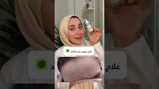 خطة علاج حبوب تحت الجلد بمنتج واحد بس اول كومنت مثبت 