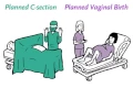 Lagu Cesarean or Vaginal Delivery for Twins | NEJM