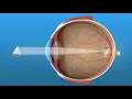 What is Refractive Error