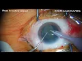 Download Lagu Phaco for Cortical cataract