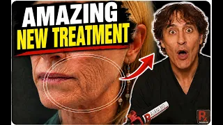 Amazing New Treatment for Wrinkles — Especially Around the Mouth