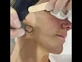 Download Lagu Carbon Laser Treatment for Skin Rejuvenation || #shorts #lasertreatment