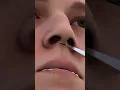Download Lagu Ever Wonder How Rhinoplasty Surgery Works!|Nose job done
