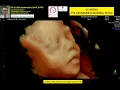 Download Lagu Skrining TM2 microdeletion markers 26 weeks