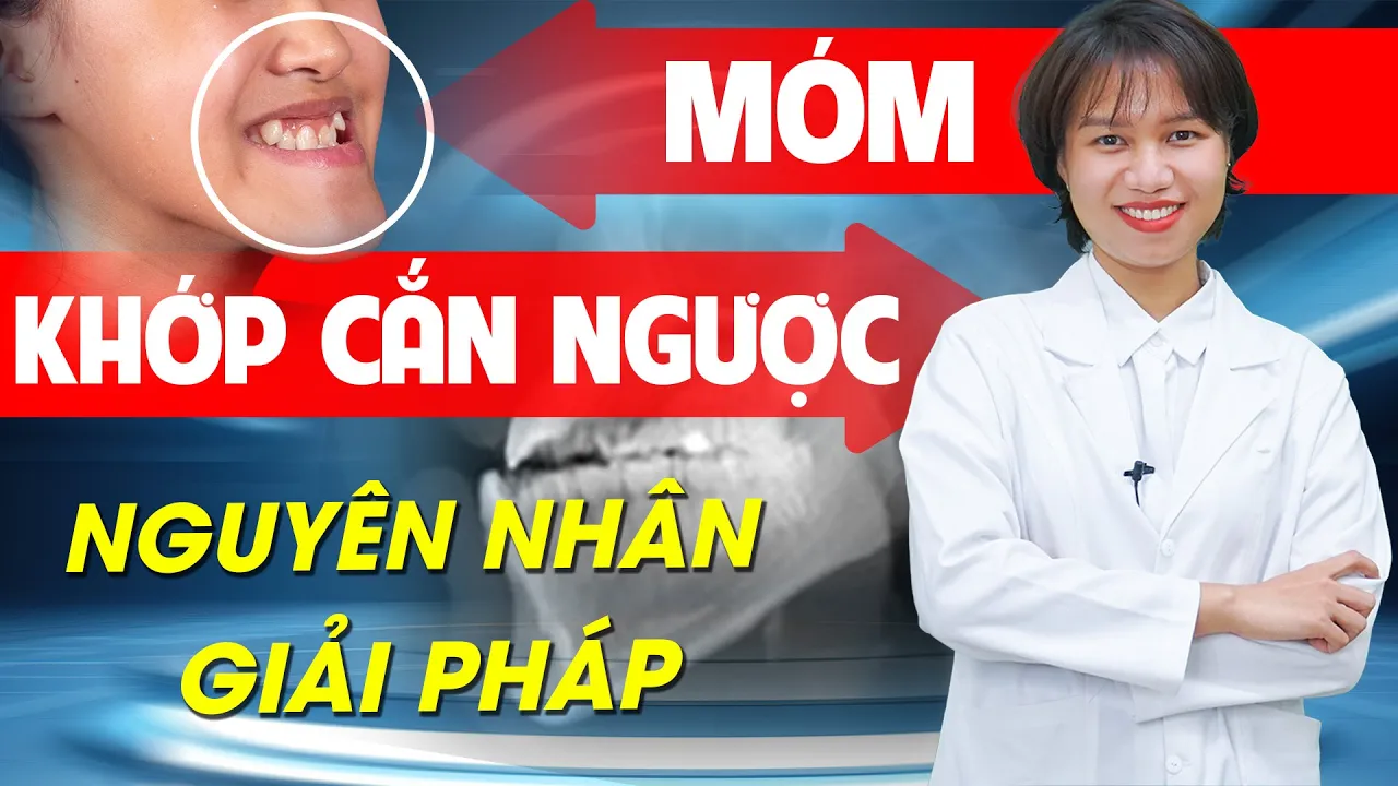 Outline Video Răng Móm - Khớp Cắn Ngược | Nguyên Nhân Và Giải Pháp, Độ Tuổi Niềng Răng Móm | Nam Bùi Vinalign
