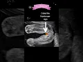 Download Lagu Ultrasound Scan Showing Baby Girl🎀 #shorts