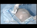 C-section Set Tutorial