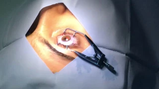 عملية ليزك تصحيح البصر د عادل الكرعاوي مركز الكرعاوي التخصصي لطب وجراحة العيون 