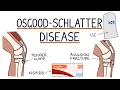 Download Lagu Understanding Osgood-Schlatter Disease