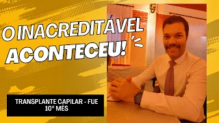 TRANSPLANTE CAPILAR - FUE EVOLUÇÃO APÓS 10 MESES