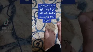علاج اللوز نهائيا بالكي 