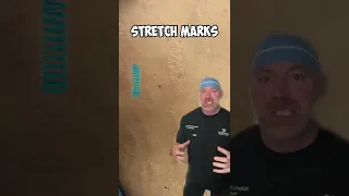 What Causes Stretch Marks