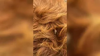 Pimple Popping - Ultimate Pimple Popping Compilation