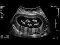 Stomach Scan for Kids What Happens If You Eat Too Much Junk Food Kids Doctor Ultrasound Prank