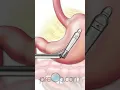 PreOp Laparoscopic Gastric Sleeve Surgery