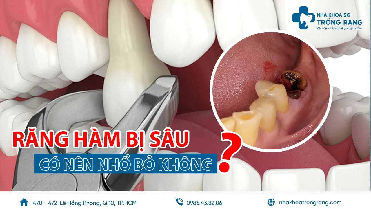 Outline Video Răng hàm bị sâu có nên nhổ bỏ không? | Cách chữa sâu răng hàm