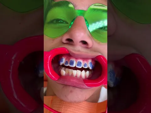 Putting Custom 3D-Printed Metal Braces On My Patient