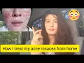 How I m Treating my Type 2 Rosacea from Home Using Horse Paste
