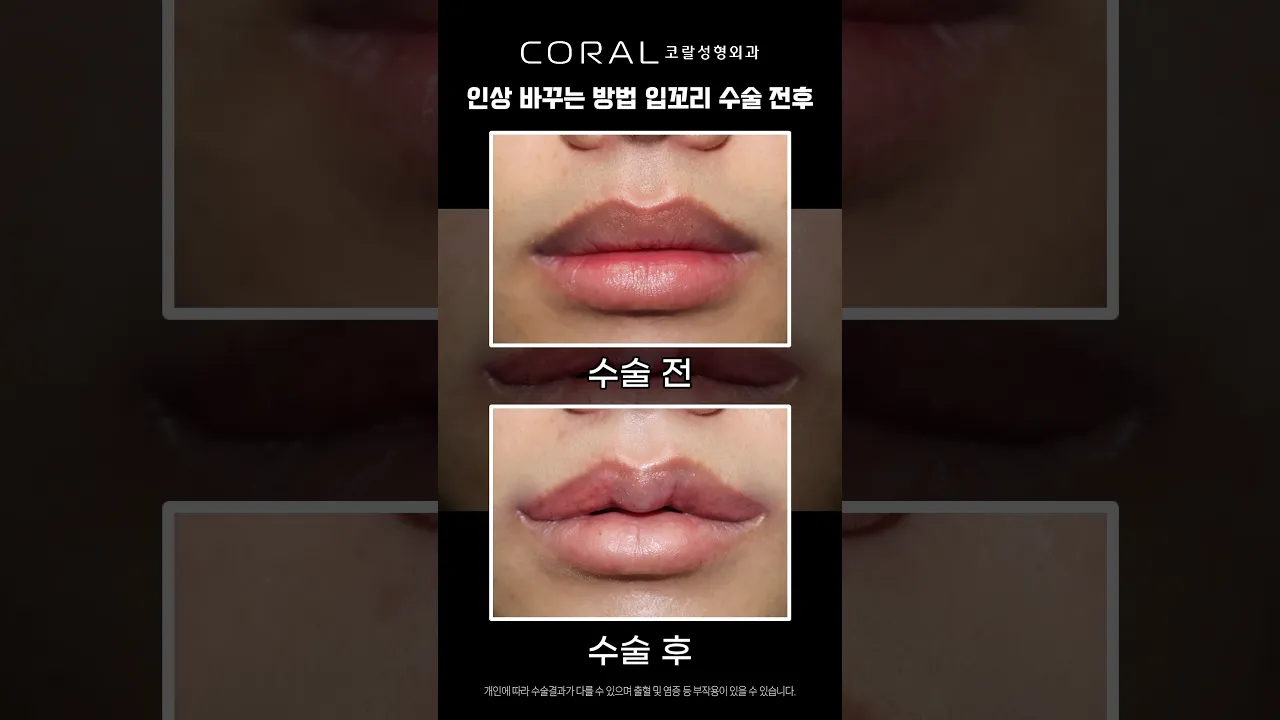 "너 무슨 일 있어?" 소리 듣던 무표정의 미친 변신...B&A 💥 #shorts  #liplift