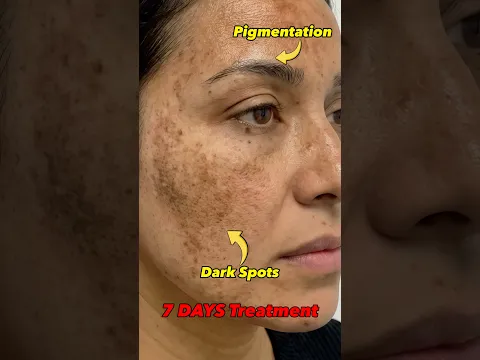 Say Goodbye to Pigmentation with This Potato Spray! 🥔 #ashortaday