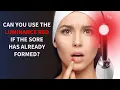 Can You Use the Luminance RED if the Lip Sore is Already Formed Lip Sore Laser Treatment