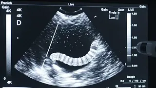 Scanning Stomach for kids scanning