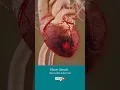 Download Lagu What happens during a heart attack? ↪ 3D Medical Animation #Shorts #HeartAttack #Heart #Health
