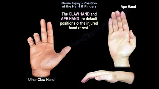 Nerve Injury Position of the Hand & Fingers
