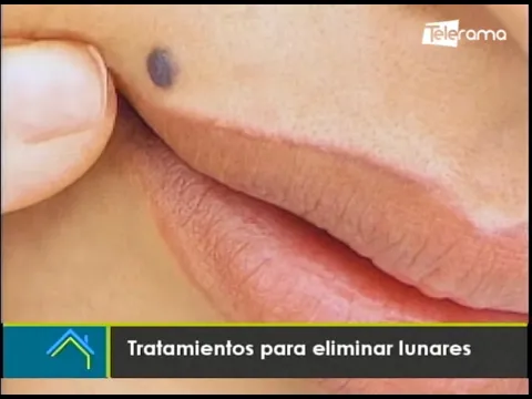 Estética al Día: Tratamiento para eliminar lunares