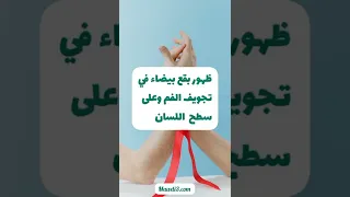 الأعراض المبكرة للإصابة بالإيدز دندنها