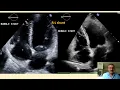 bubble test 2 agitated saline interpretation