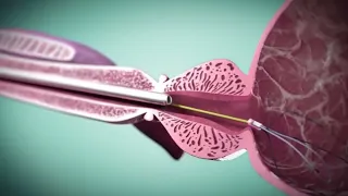 شاهد كيف يتم علاج تضخم البروستاتا بأحدث الطرق Prostate Enlargement 