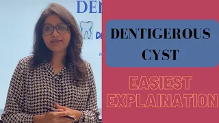 DENTIGEROUS CYST - SIMPLIFIED I DENTAL LECTURE I ORAL PATHOLOGY
