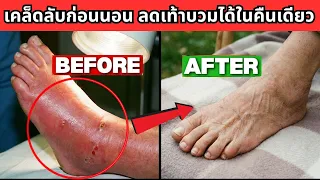 ความเชื่อผิดๆ ที่พบบ่อยเกี่ยวกับการดูแลอาการบวมมีอะไรบ้าง และเหตุผลที่ผิดคืออะไร