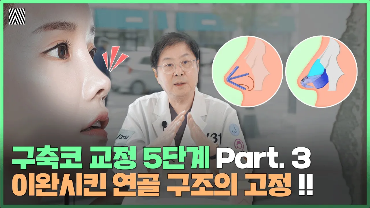 #3 구축코 교정 시 이완시킨 연골 구조를 정확하게 고정하는 방법!_[4월31일 성형외과]