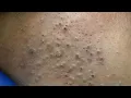 Facial Deep Cleanse Ultimate Blackhead Removal Techniques