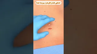 عملية استئصال المرارة 