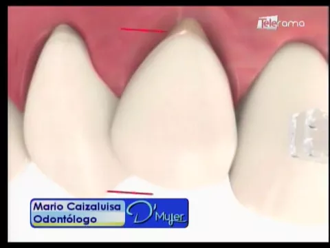 Brackets para adultos no es tarde para corregir la sonrisa