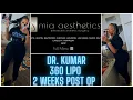 MIA AESTHETICS BALTIMORE 360 LIPO 2 WEEKS POST OP